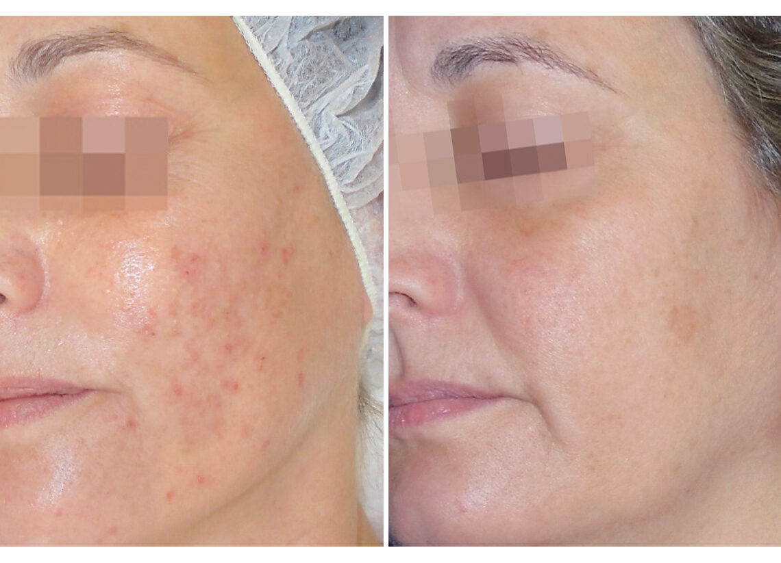 acnelan pre i posle 1