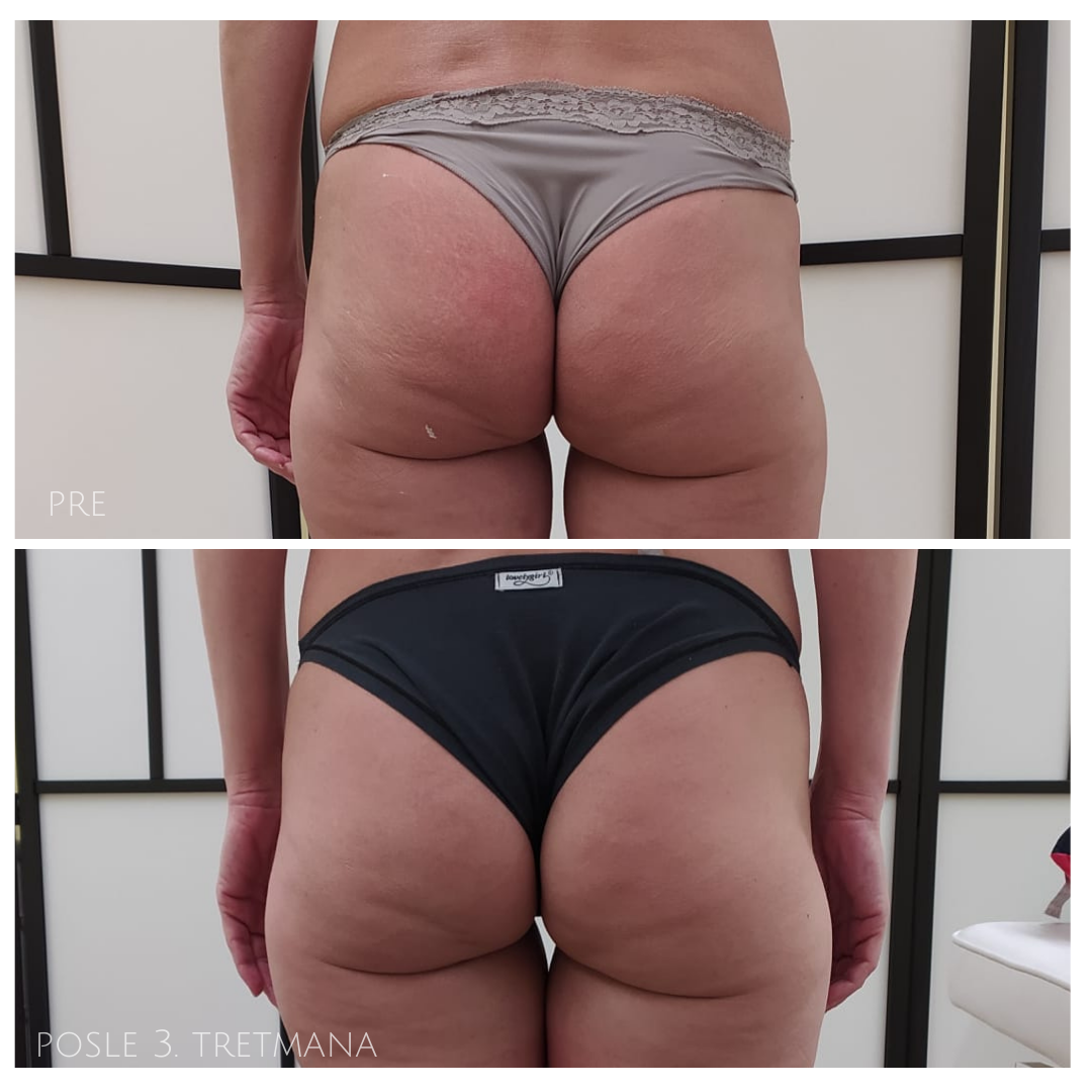 anticelulit pre i posle