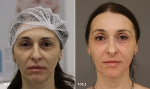Hijaluronski fileri i CO2 laser pre i posle
