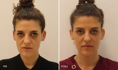 Hijaluronski fileri pre i posle