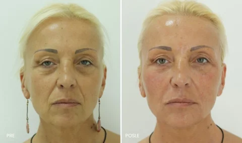Podmlađivanje lica hijaluronskim filerima pre i posle