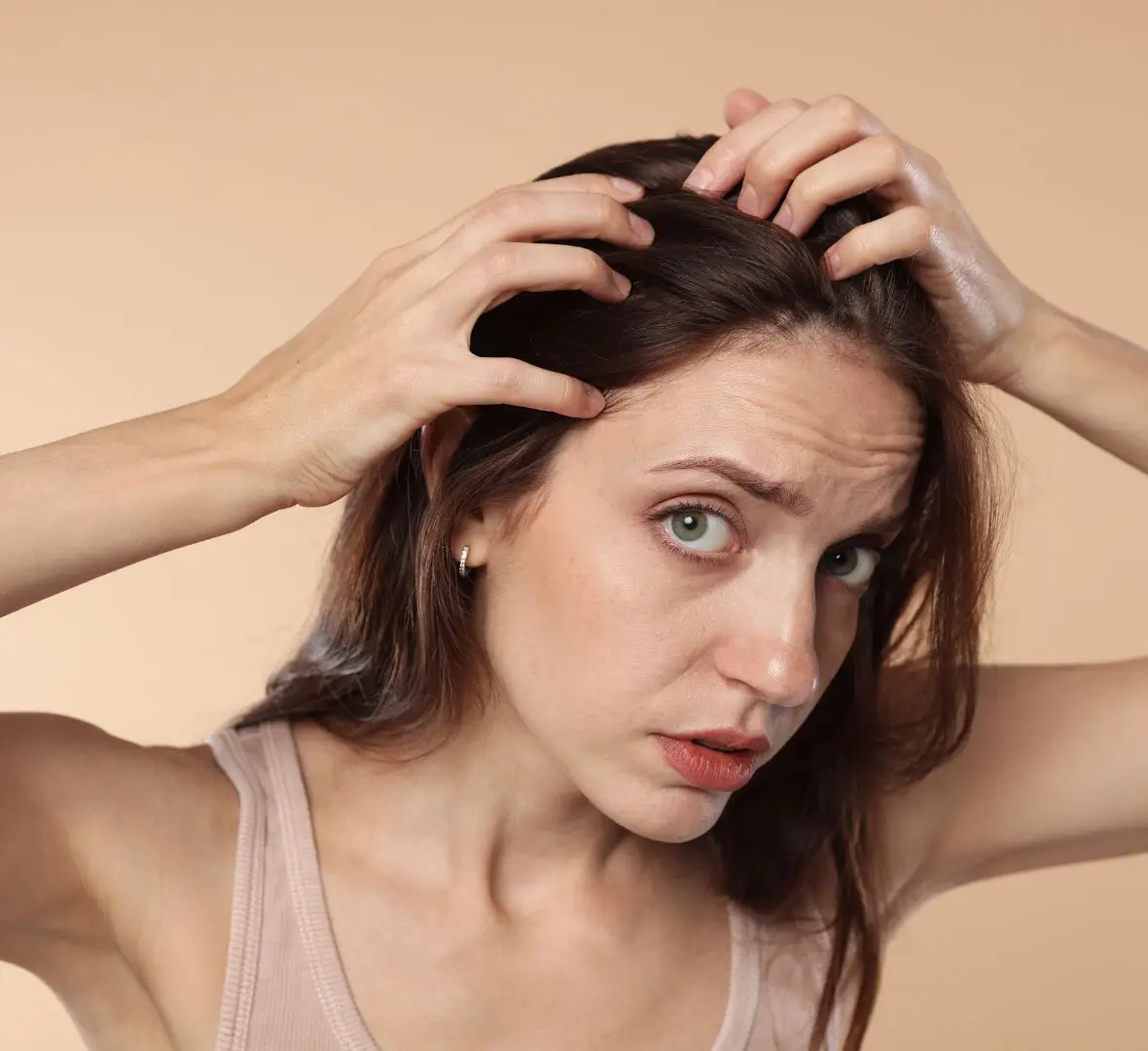 Androgenetska alopecija kod žena