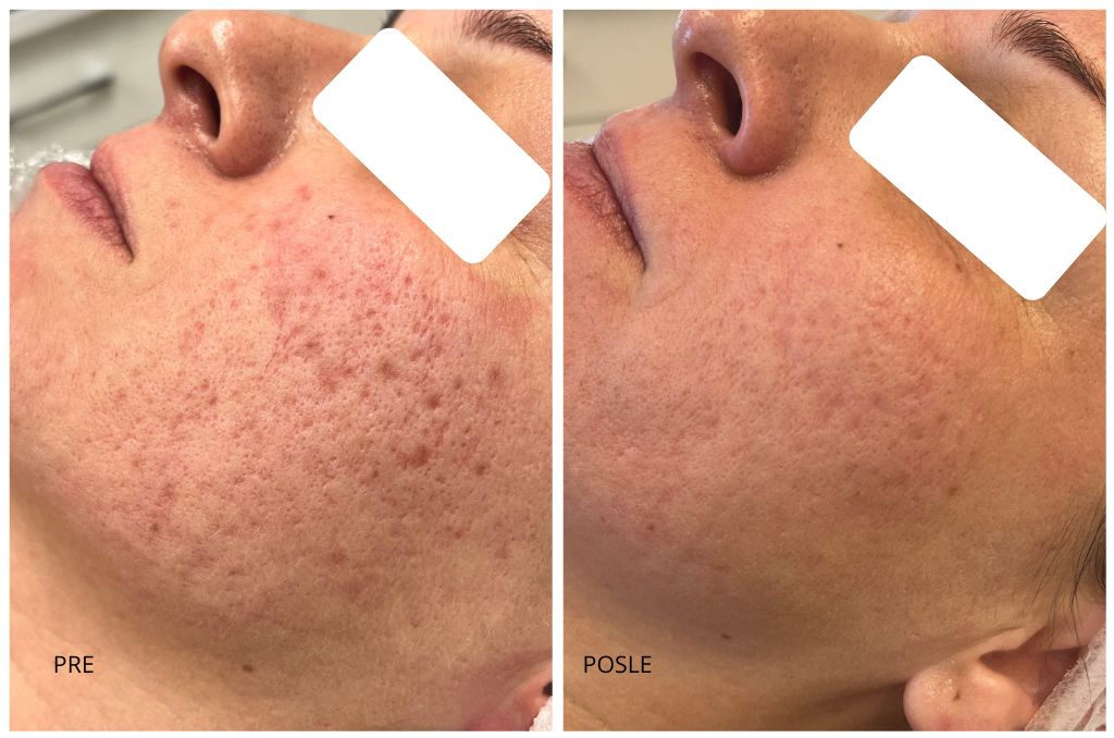 ožiljci od aki pre i posle co2 laser