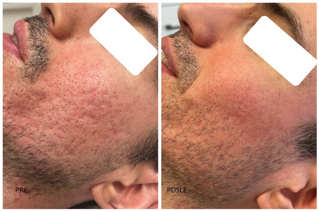 ožiljci od aki pre i posle co2 laser
