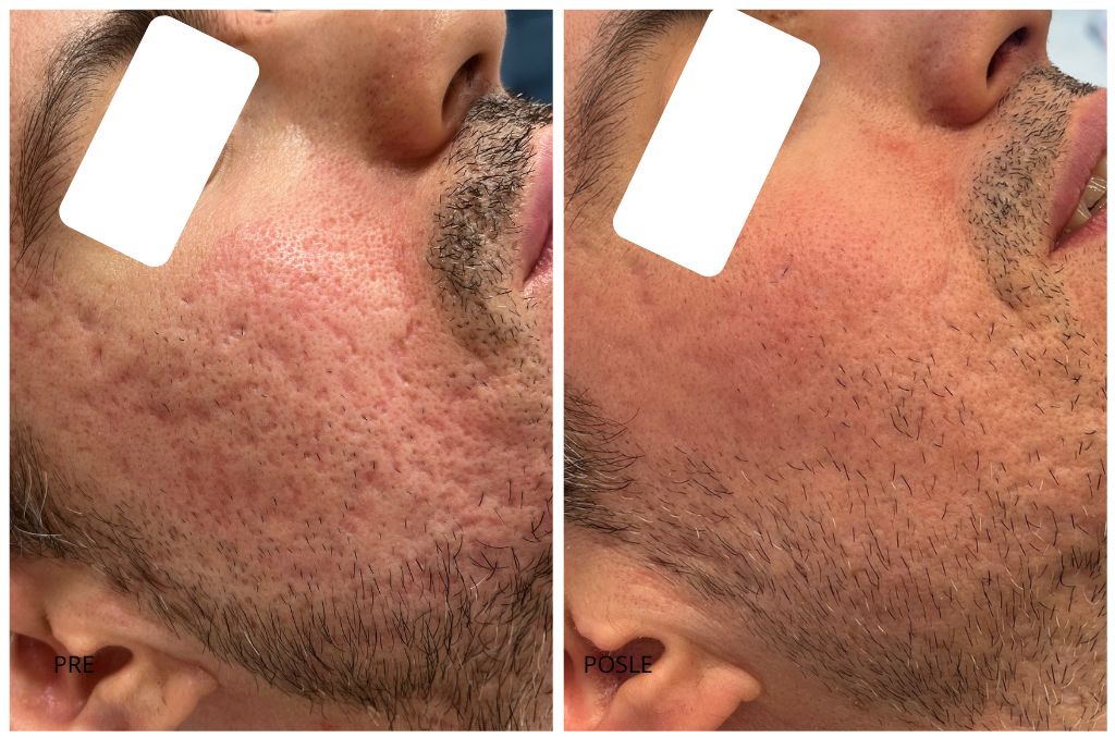 ožiljci od aki pre i posle co2 laser