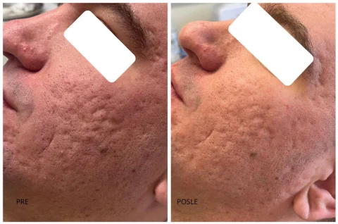 ožiljci od aki pre i posle co2 laser