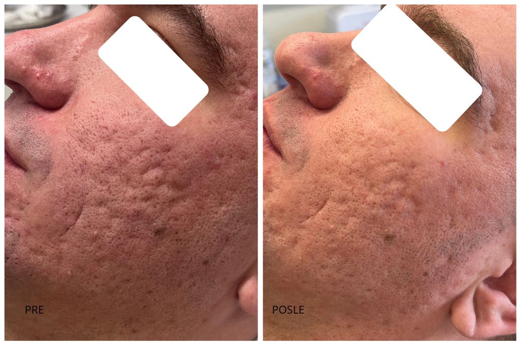 ožiljci od aki pre i posle co2 laser
