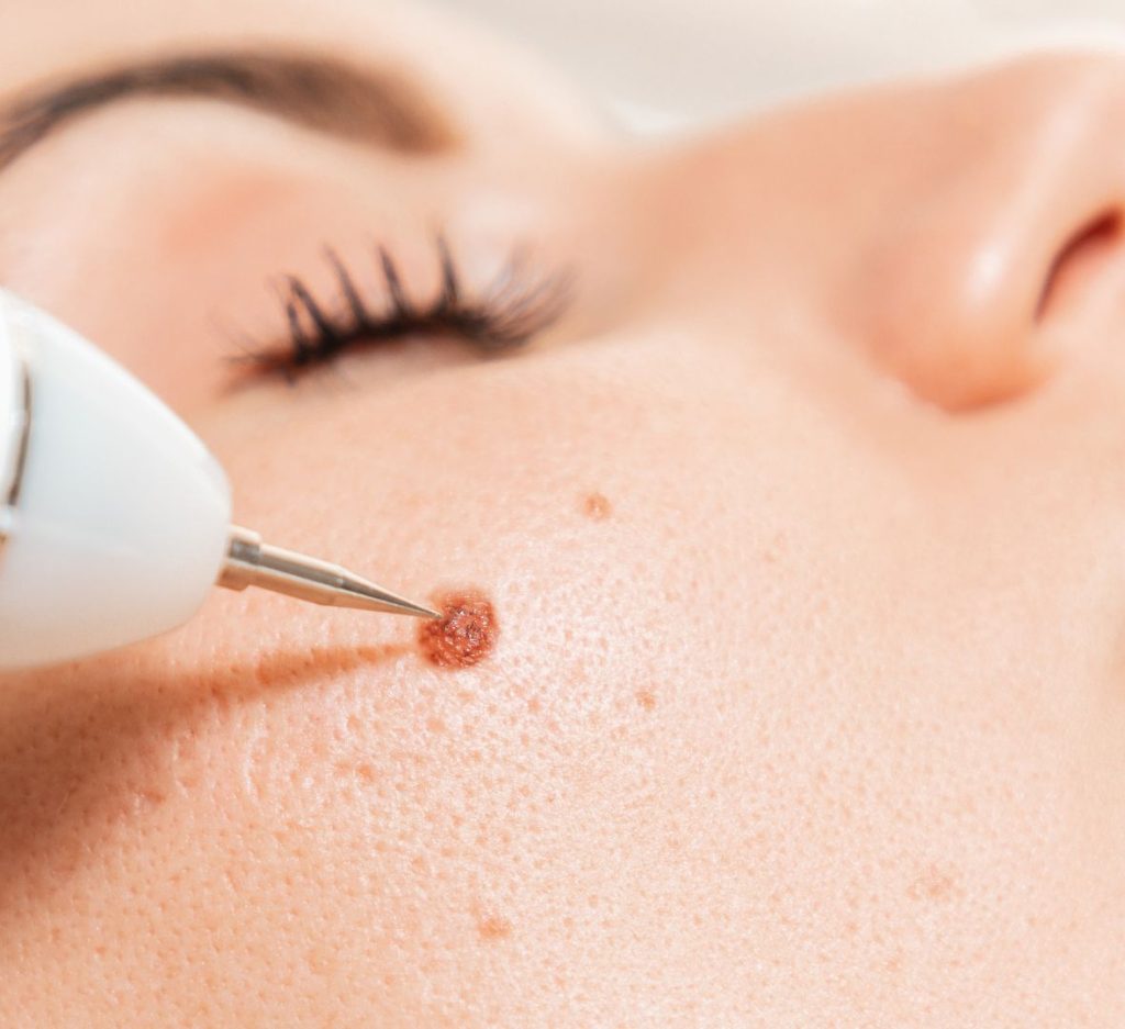 Uklanjanje bradavica