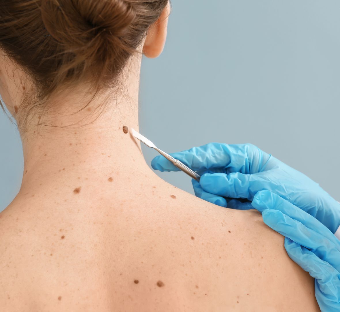 Uklanjanje mladeža radiotalasima