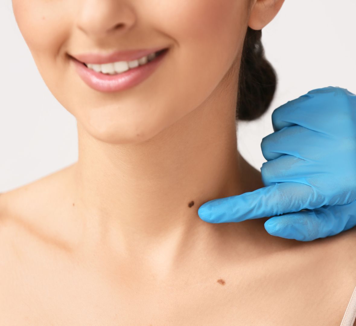 Uklanjanje mladeža radiotalasima