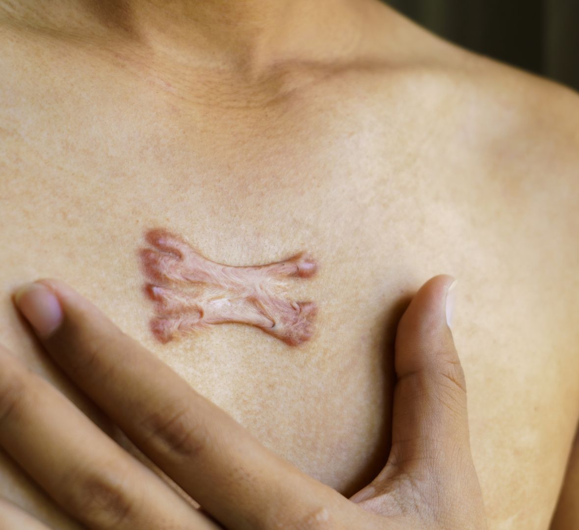 keloid hipertrofični ožiljci