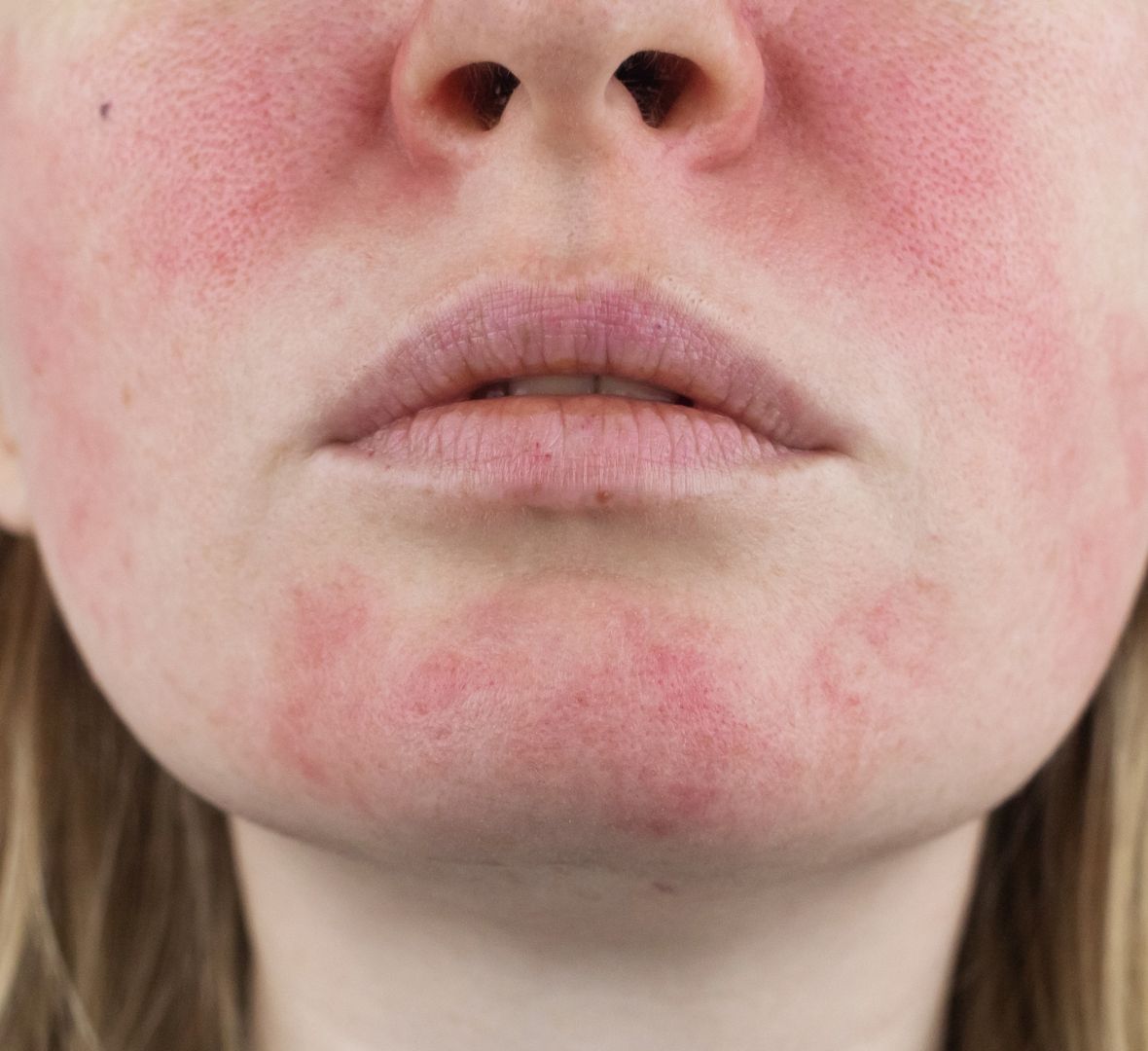 rozacea
