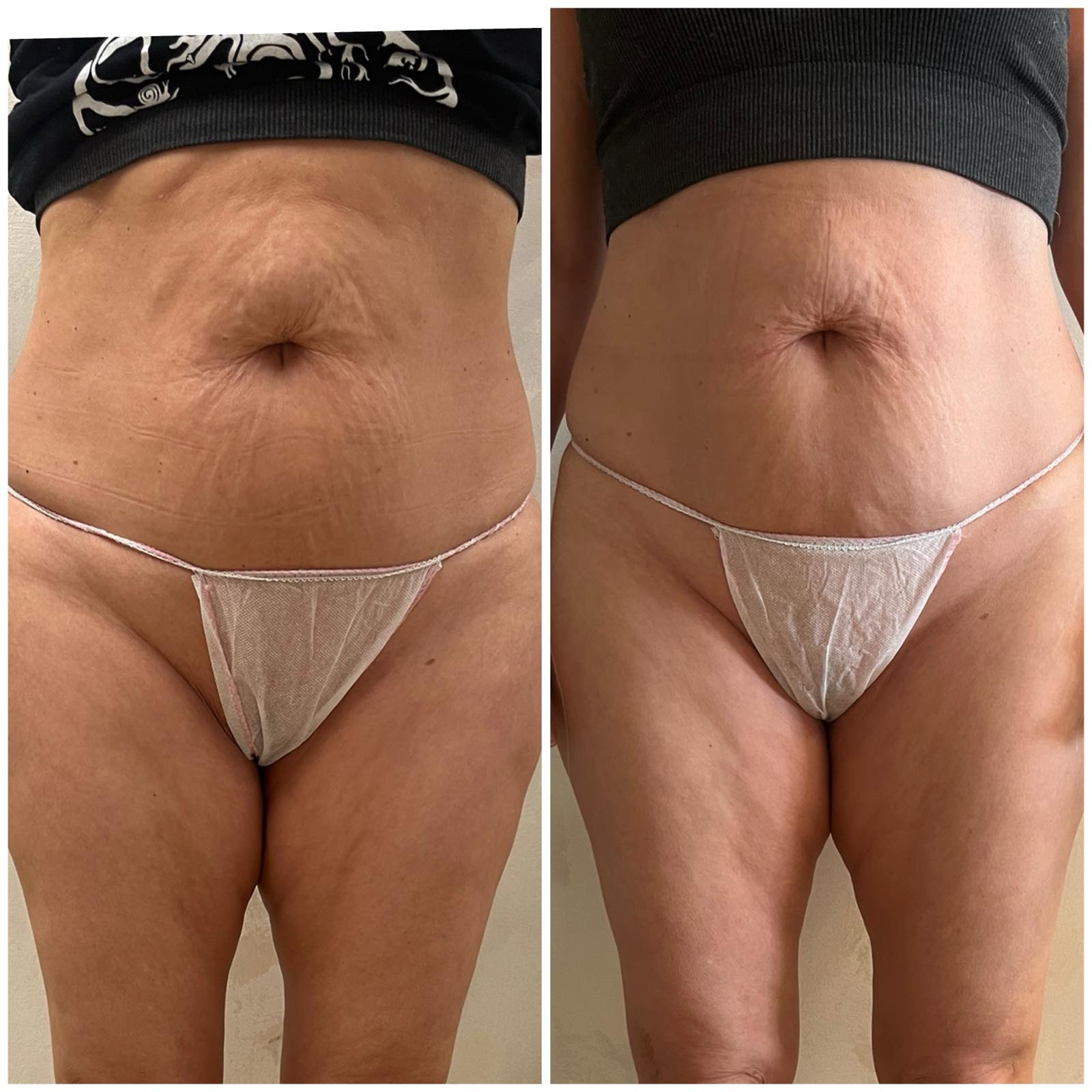 pre i posle stomak menopauza