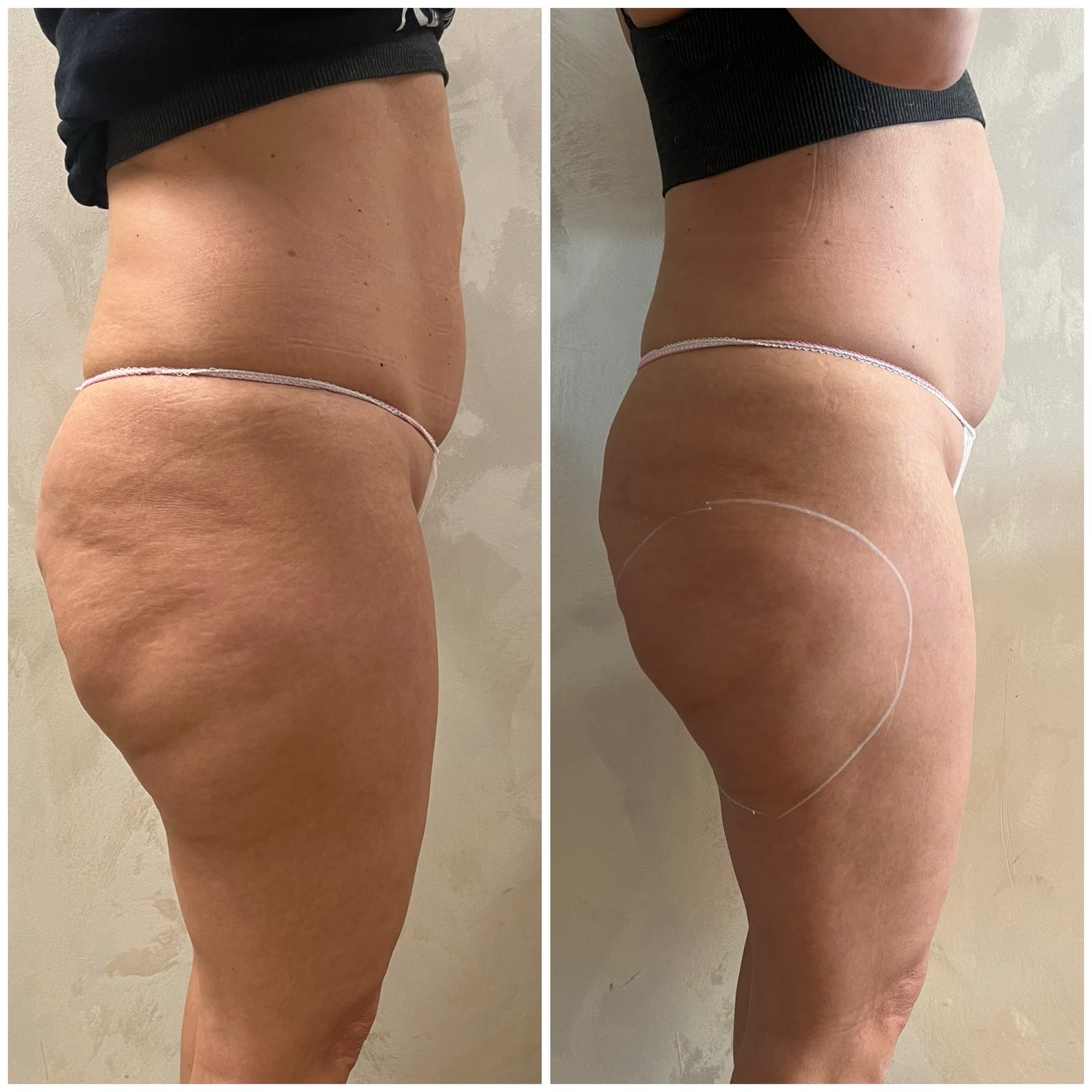 pre i posle stomak menopauza