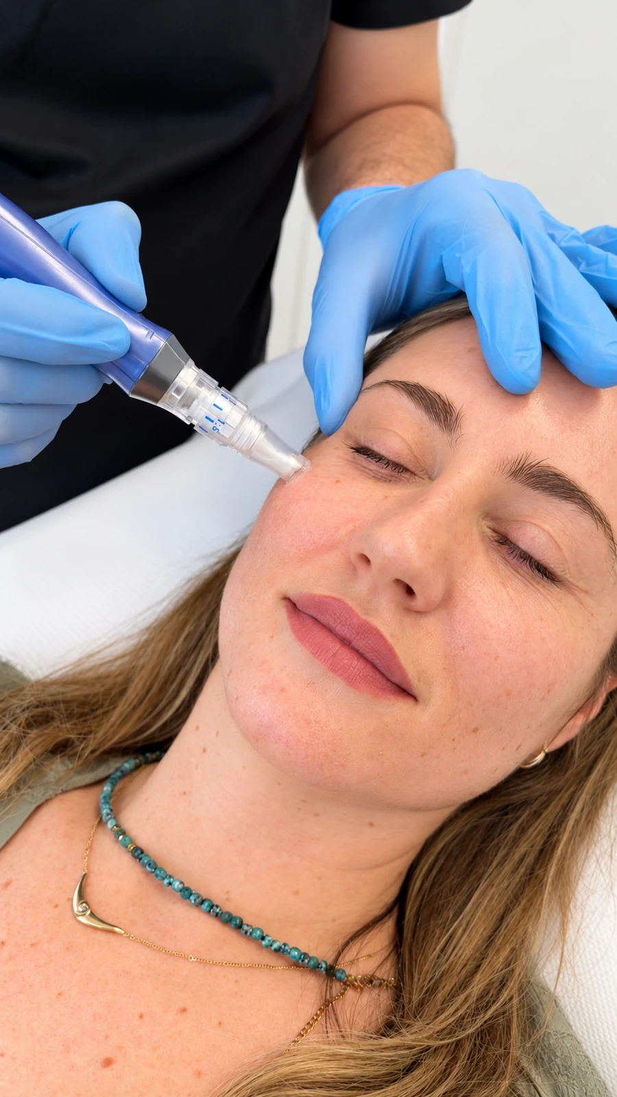 SkinPen