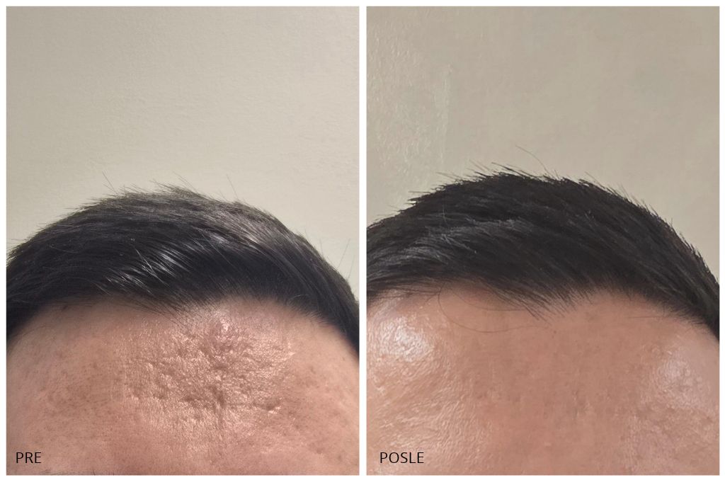 3 CO2 treatments + 3 polynucleotide treatments + 1 exosome and dermapen treatment